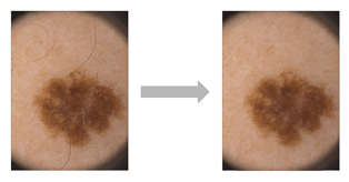 Pedro Bibiloni Tesi 2018 Imatge HairRemoval